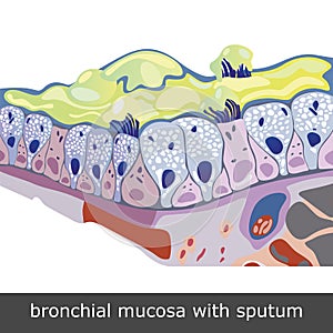 Bronchial Mucosa with Sputum photo