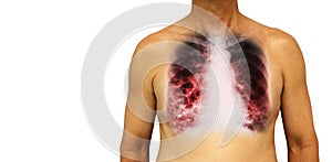 Bronchiectasis . Human chest with x-ray chest show multiple lung bleb and cyst due to chronic infection . Isolated background . B