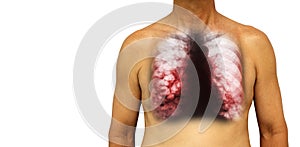 Bronchiectasis . Human chest with x-ray chest show multiple lung bleb and cyst due to chronic infection . Isolated background . B