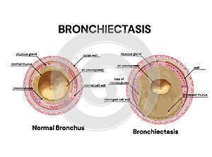 Bronchiectasis. lung disease. Normal bronchus and bronchiectasis.Vector medical illustration. photo
