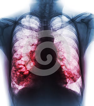 Bronchiectasis . X-ray chest show multiple lung bleb and cyst due to chronic infection . Front view