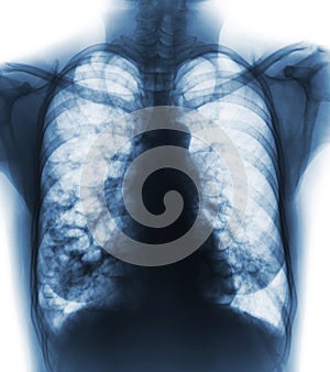 Bronchiectasis . X-ray chest show multiple lung bleb and cyst due to chronic infection . Front view