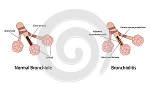 Bronchiolitis vector illustration
