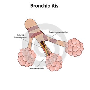 Bronchiolitis vector illustration