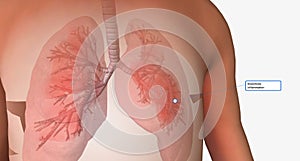 Bronchiolitis is a respiratory condition in which the bronchioles become infected and inflamed photo