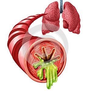 Bronchitis Anatomy Concept photo