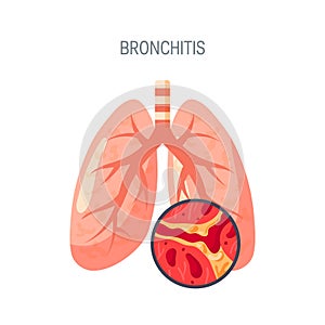Bronchitis disease vector icon in flat style