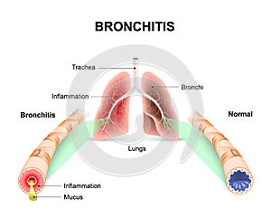 Bronchitis photo