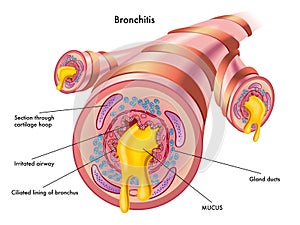 Bronchitída 