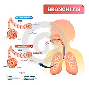Bronchitis vector illustration. Lung disease diagnosis with symptoms. photo