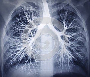 Bronchoscopy image. Chest X-ray. Healthy lungs