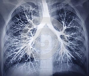 Bronchoscopy image. Chest X-ray. Healthy lungs photo