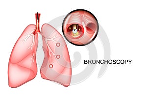 Bronchoscopy of the lungs, sectional view photo