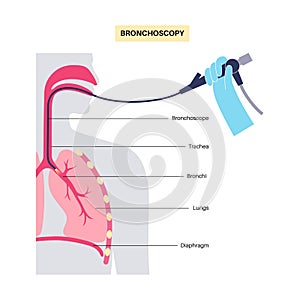 Bronchoscopy procedure concept