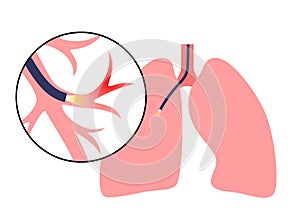 Bronchoscopy procedure concept photo