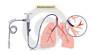 Bronchoscopy procedure concept photo