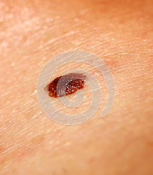 Brown birthmark. Brown mole large size. Stain on the skin