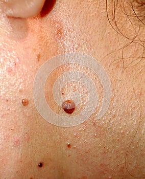 Brown birthmark. Brown mole large size. Stain on the skin