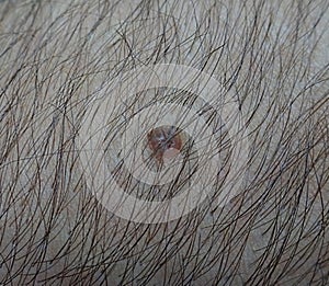 Brown mole on the hairy arm skin