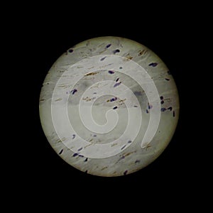 Brown myocardial atrophy