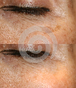 Brown spot on the skin of the face. Pigmentation on the skin. After laser removal photo