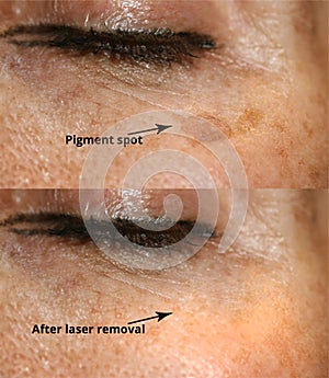 Brown spot on the skin of the face. Pigmentation on the skin. After laser removal photo