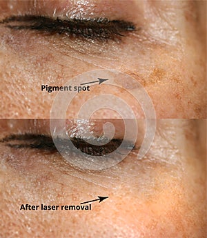 Brown spot on the skin of the face. Pigmentation on the skin. After laser removal