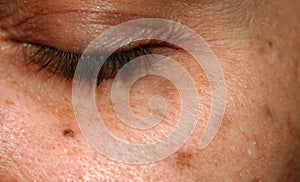 Brown spots on the face. Pigmentation on the skin. Brown age spots on the cheek.