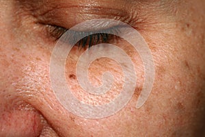 Brown spots on the face. Pigmentation on the skin. Brown age spots on the cheek.