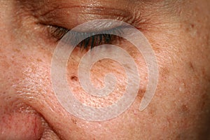 Brown spots on the face. Pigmentation on the skin. Brown age spots on the cheek. photo