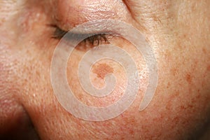 Brown spots under the eye. Pigmentation on the face photo