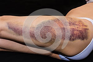 Bruise on wounded woman leg