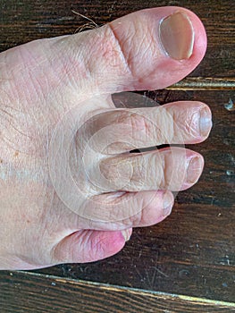 Bruised fractured little toe of a man in close up