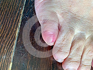 Bruised fractured little toe of a man in close up