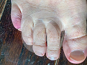 Bruised fractured little toe of a man in close up