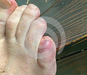 Bruised fractured little toe of a man in close up