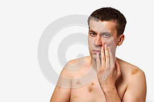 Brunette man with bruises on his body holds hand to his head in pain after a fight on a white isolated background
