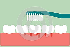 Brushing teeth with bleeding on gum and tooth concept gingivitis or scurvy