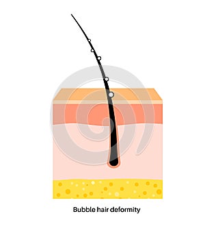 Bubble hair deformity