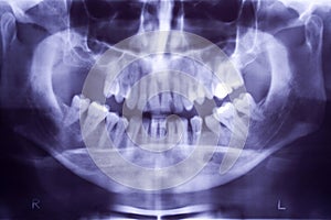 Buccal x-ray photo