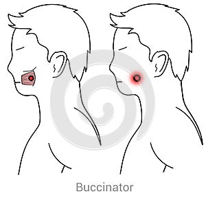 Buccinator myofascial trigger points can make chewing difficult and cause cheek pain
