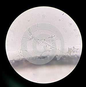 Budding yeast cells with pseudohyphae in urine sample