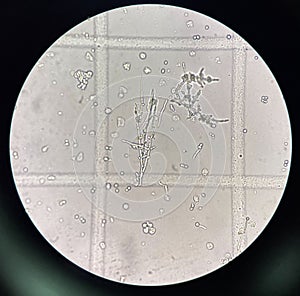 Budding yeast with pseudo hephae in urine