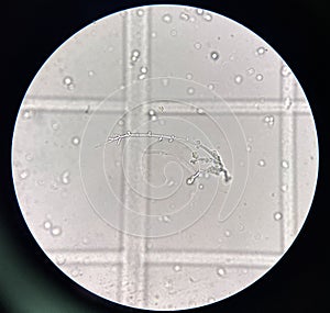 Budding yeast with pseudo hephae in urine