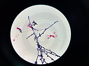 Budding yeast with pseudo hephae in urine