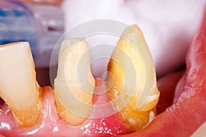 Buffed teeth before imprinting