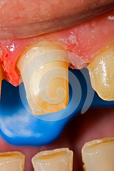 Buffed teeth - prosthetic rehabilitation