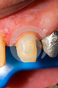 Buffed teeth - prosthetic rehabilitation