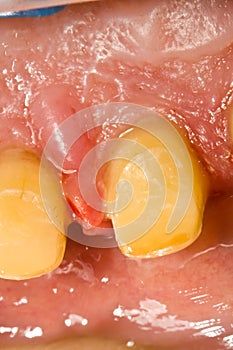 Buffed teeth - prosthetic rehabilitation