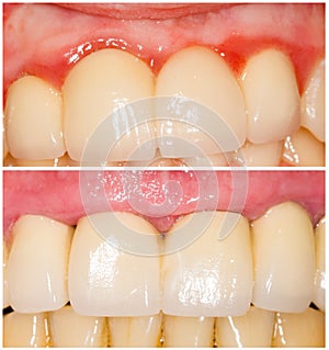 Buffing Teeth Tangent and with Shoulder photo